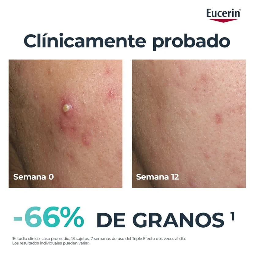 EUCERIN DERMOPURE CLINICAL TRIPLE ACCIÓN 40ML